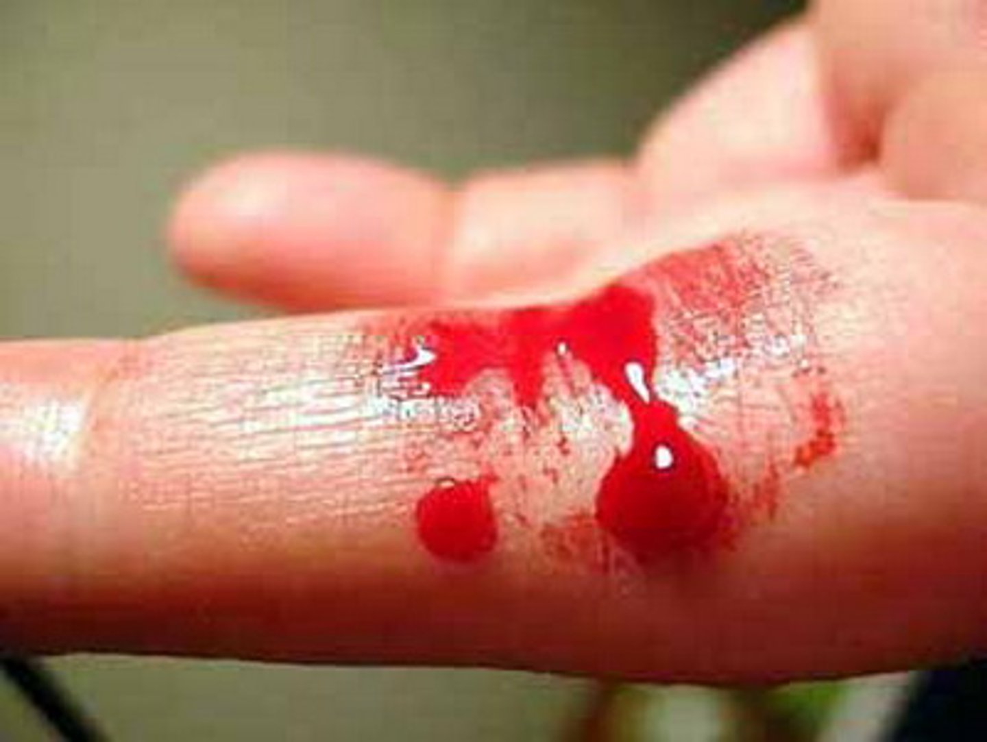 <p>Disease characterized by the inability to clot blood due to a lack of the clotting enzyme Factor VIII; passed on from mother to son</p>