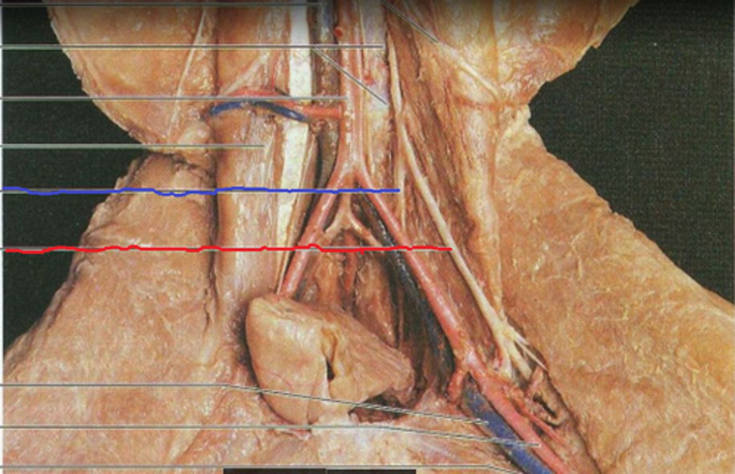 <p>To what nerve is the red line pointing?</p>