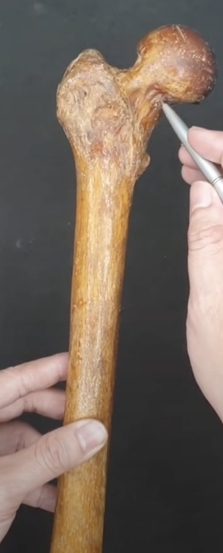 <p><span style="color: red"><strong>FEMORAL NECK</strong></span></p>