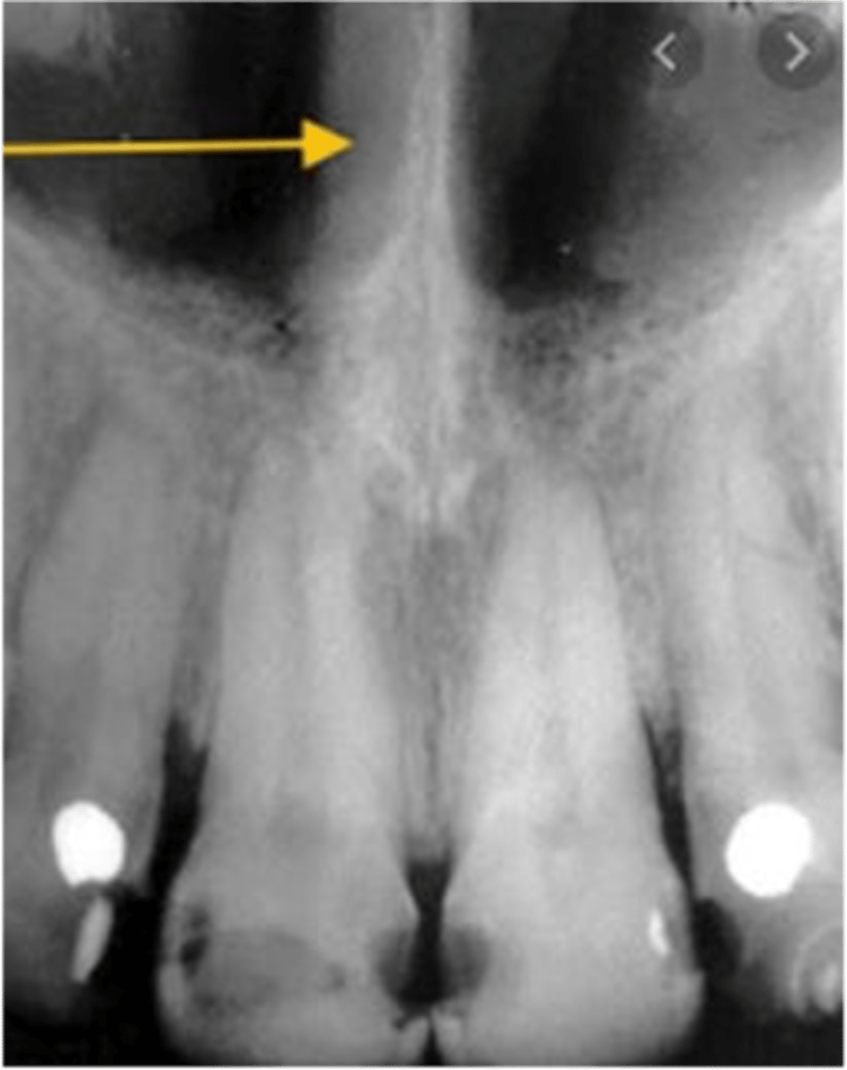 <p>What is the radiopaque structure seen here?</p>