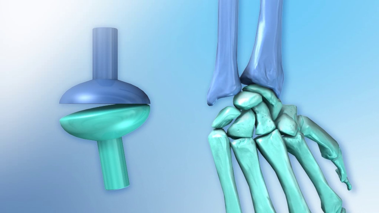 * A joint where the bones move in a single plane like a hinge.

Example: the carpus