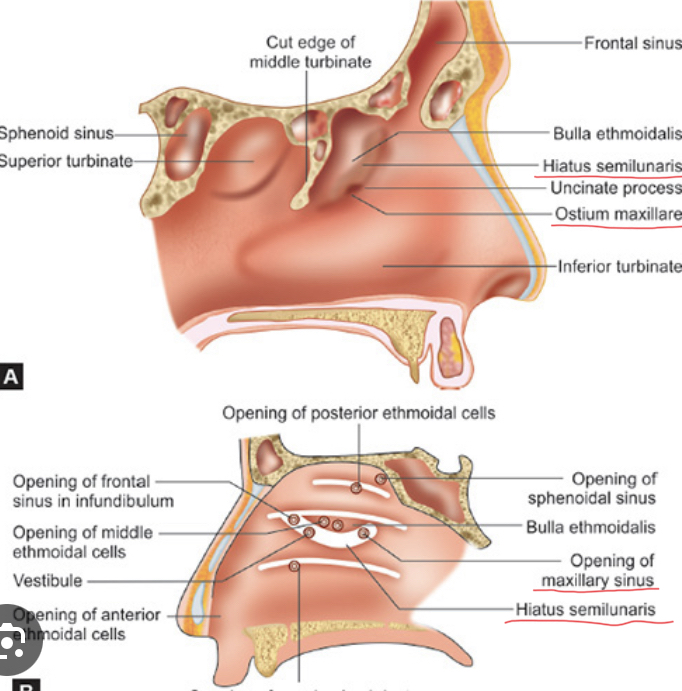 <p>Ostium maxillare  (opening of mx sinus that drains into the hiatus semilunaris of middle meatus of the nasal cavity)</p>