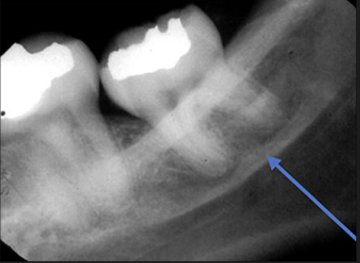 <p>A radio opaque streak that follows the line of the jaw.</p>