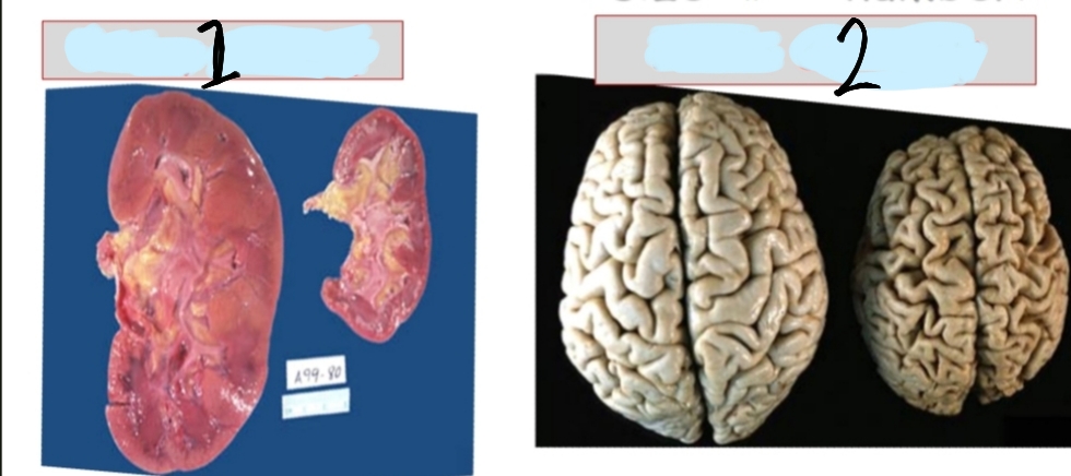 <p>What is depicted in this image and what is the definition of this condition?</p>
