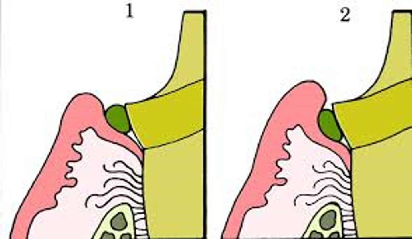 <p>Which diagram is incorrect cord packing?</p>