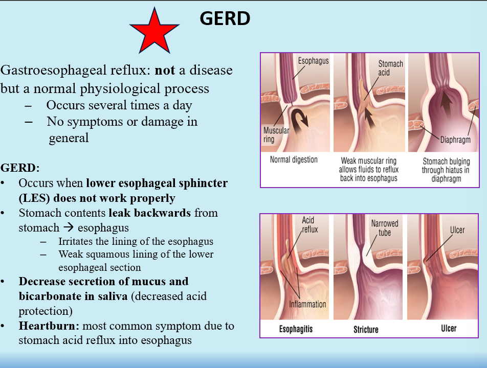<p>Gastroesophageal reflux disease, common</p><p>LES doesn’t work right</p><p>Stomach contents leak back into the esophagus</p><p>Decreased secretion of mucus and bicarb in saliva (decreased protection against acid)</p><p>Heartburn!!</p>