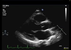 <p>What can be evaluated concerning the Right Ventricle (RV) in the PSLA view?</p>