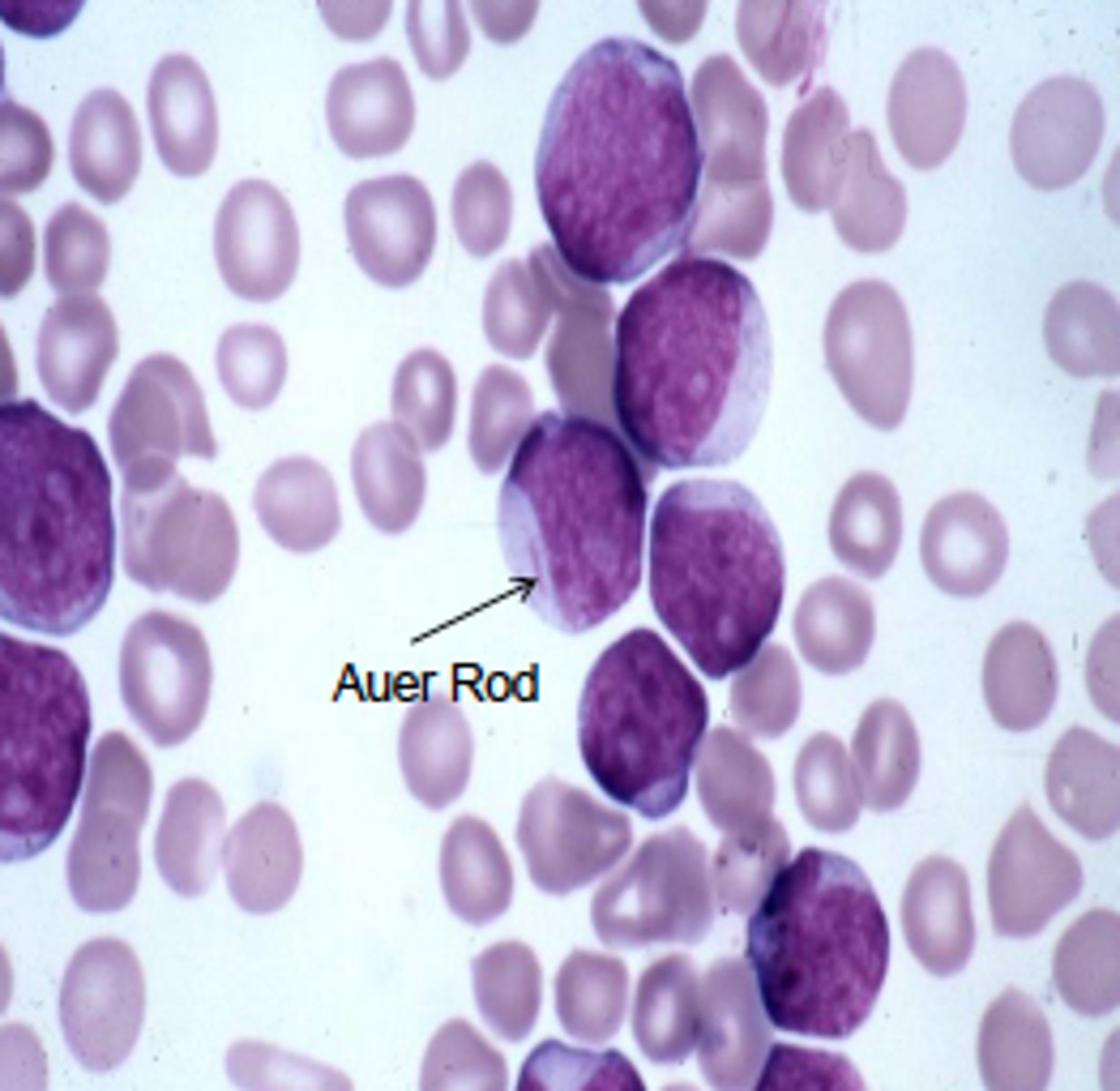 <p>- caused by mutation that affects differentiation</p><p>- blast cells replicate w/o differentiating</p><p>- affects committed myeloid progenitor (younger pts), pluripotent stem cell (older pts)</p><p>- peaks in 60s</p><p>- presence of Auer rod after staining</p><p>- causes anemia, neutropenia, thrombocytopenia</p>