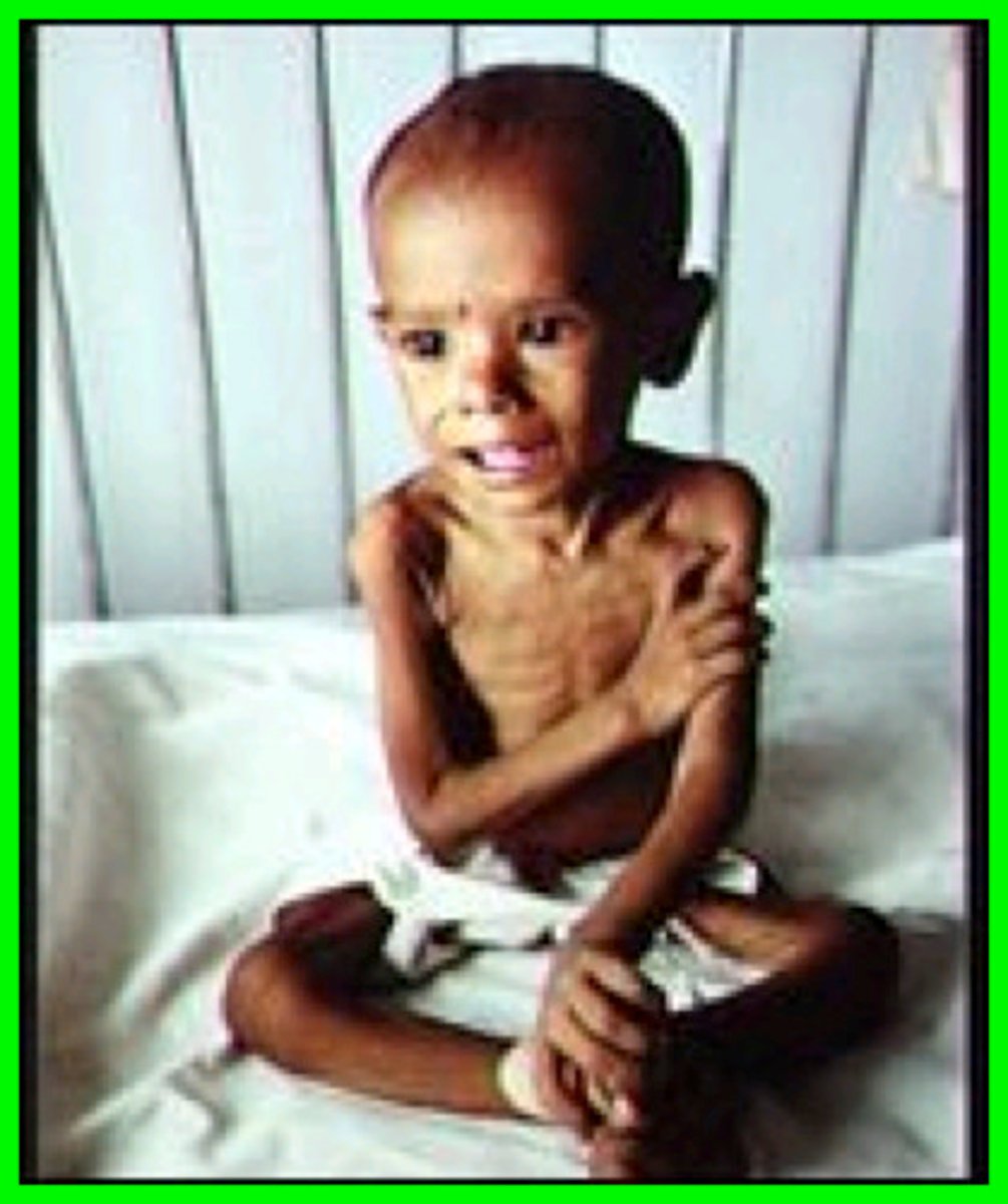 <p>Occurs in infants</p><p>Stravation; inadequate protein and calories</p><p>seen in impoverished nations</p><p>Impairs brain development &amp; learning</p><p>muscles waste away/weak. Poor growth</p>