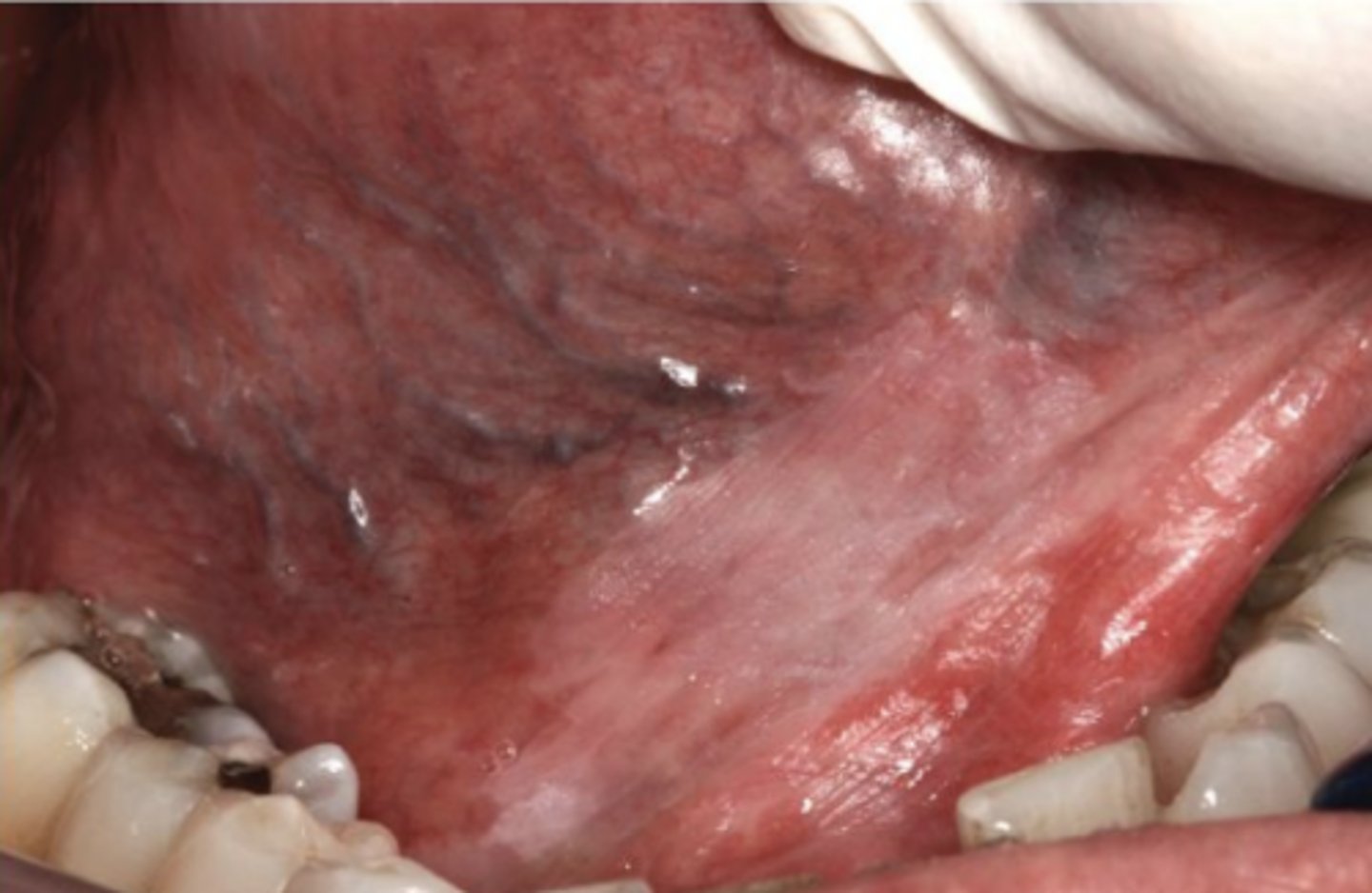 <p>A white patch or plaque that CANNOT be characterized clinically or pathologically as any other disease</p>