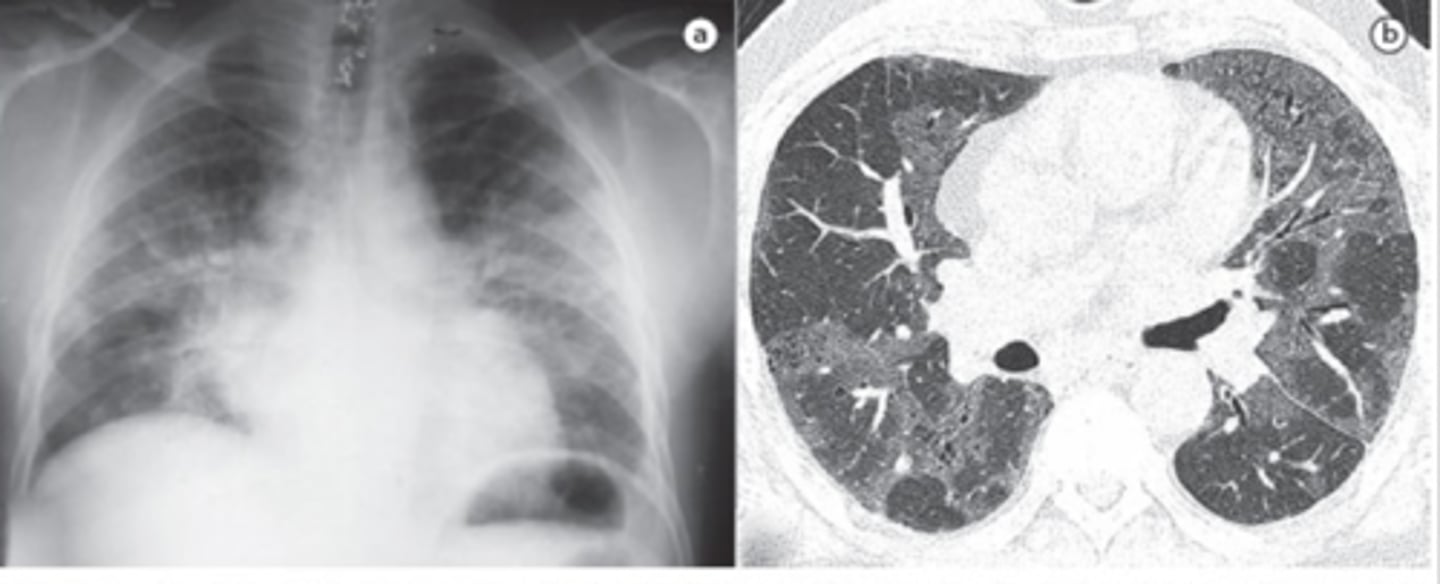 <p>What does this CXR show?</p><p>What are the key words that describe the pattern seen in this CXR?</p>