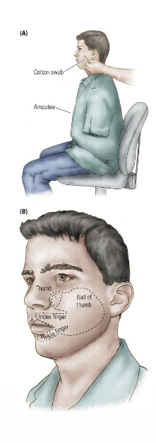 <p>Peripheral stimulation of the face produces the sensation of touch at the amputated arm (i.e. phantom pain).</p><ul><li><p>Occurs because the ‘unused’ (“deafferented”) areas in the somatosensory cortex (e.g. for the lost arm) start to respond to input from adjacent areas (e.g. the face). </p><ul><li><p>At the <u>cortical level</u>, the ‘arm area’ is now mapped to the face. </p></li></ul></li></ul><p></p><p>This is called <span style="color: red"><strong>cortical reorganization</strong></span>. </p>