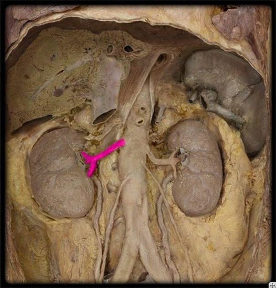 <p>Name this specific vessel (include the side).</p>