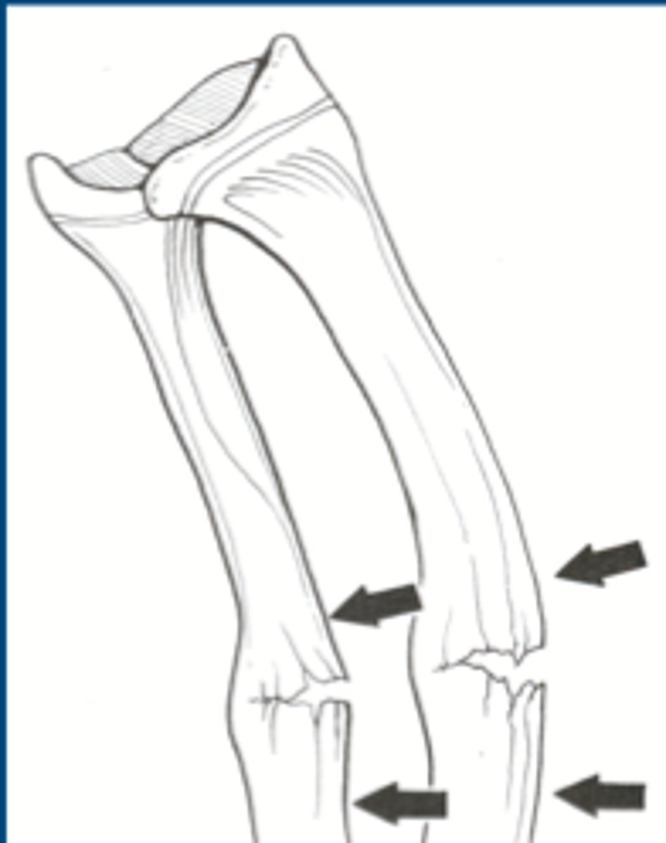 <p>incomplete, and the break occurs on the convex surface of the bend in the bones</p>