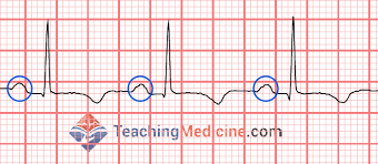 <p>Depolarisation of atrial contractile fibres at the SA node produces the small P wave. </p>