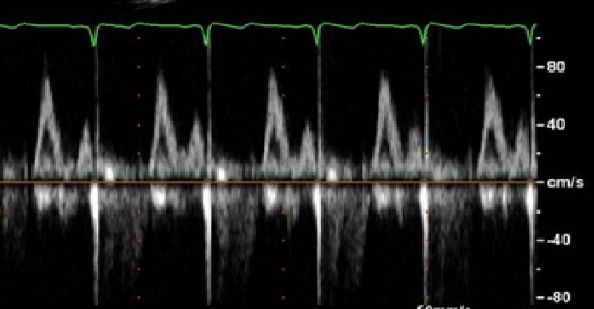 <p>Identify the spectral Doppler waveform:</p>