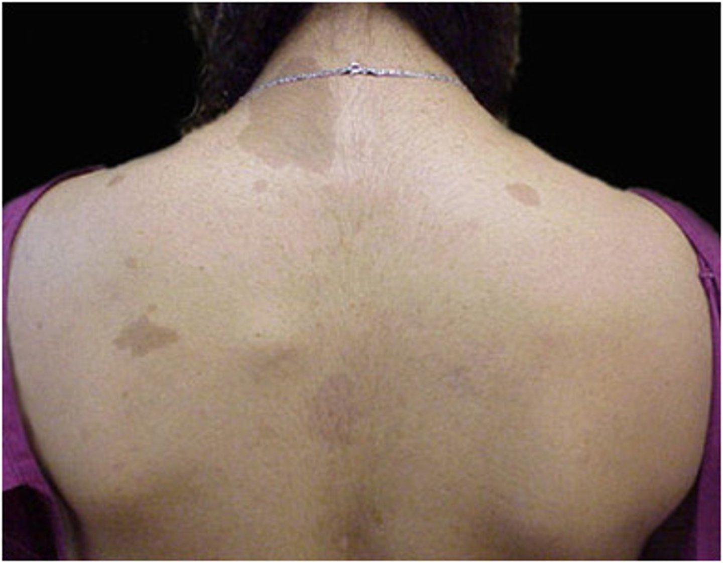 <p>pigmented light-brown lesions 1-2cm in size</p><p>Isolated lesions have no significance</p><p>Multiple lesions suggest neurofibromatosis</p>