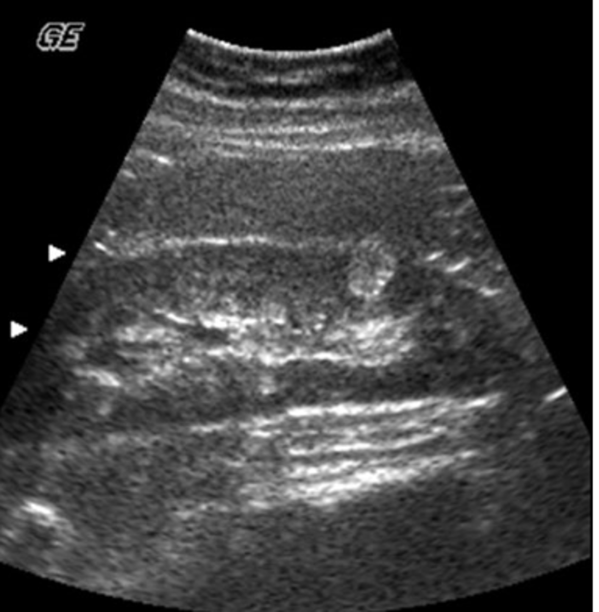 <p>What term best describes this lower pole renal mass?</p><p>a. hypoechoic</p><p>b. anechoic</p><p>c. isoechoic</p><p>d. hyperechoic</p><p>e. none of the above</p>