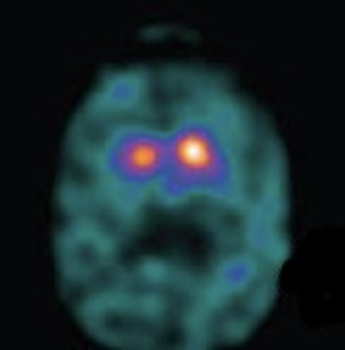 <p>positive for parkinson's disease</p>