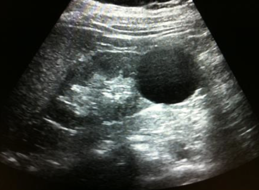 <ul><li><p><mark data-color="yellow" style="background-color: yellow; color: inherit;">anechoic</mark></p></li><li><p>smooth, thin, well-defined</p></li><li><p><mark data-color="yellow" style="background-color: yellow; color: inherit;">round</mark> or oval shape</p></li><li><p>sharpe interference between cyst and renal parenchyma</p></li><li><p>increased posterior acoustic <mark data-color="yellow" style="background-color: yellow; color: inherit;">enhancement</mark></p></li></ul><p></p>