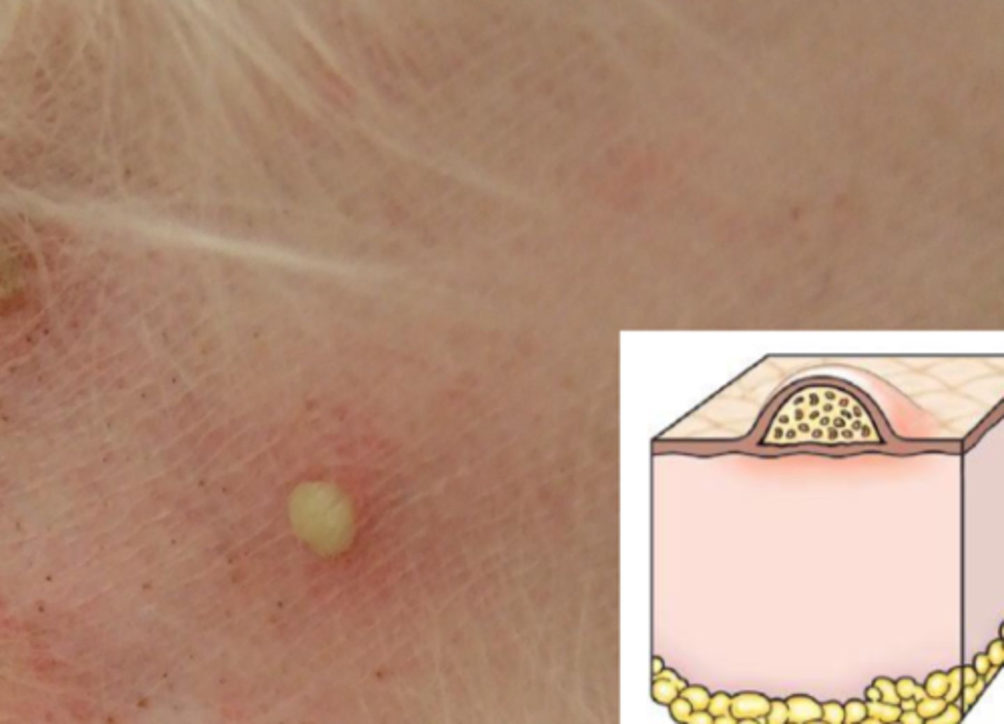 <p>What lesion is this? Is it primary or secondary?</p>