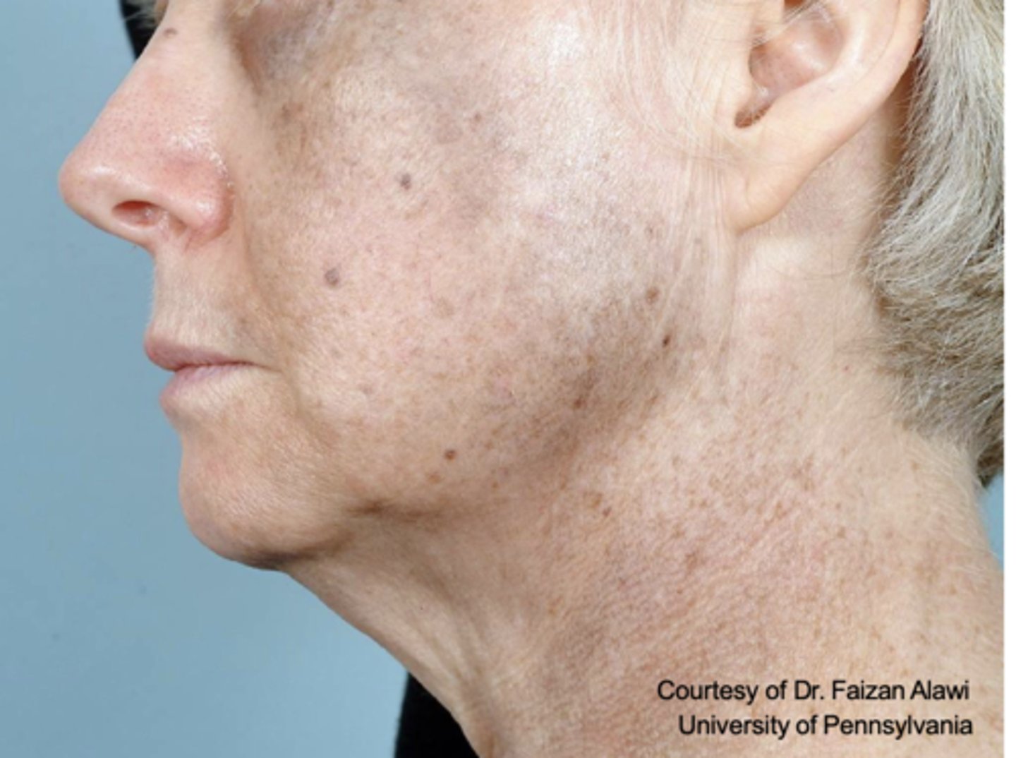 <p>Skin hyperpigmentation can be caused by what?</p>