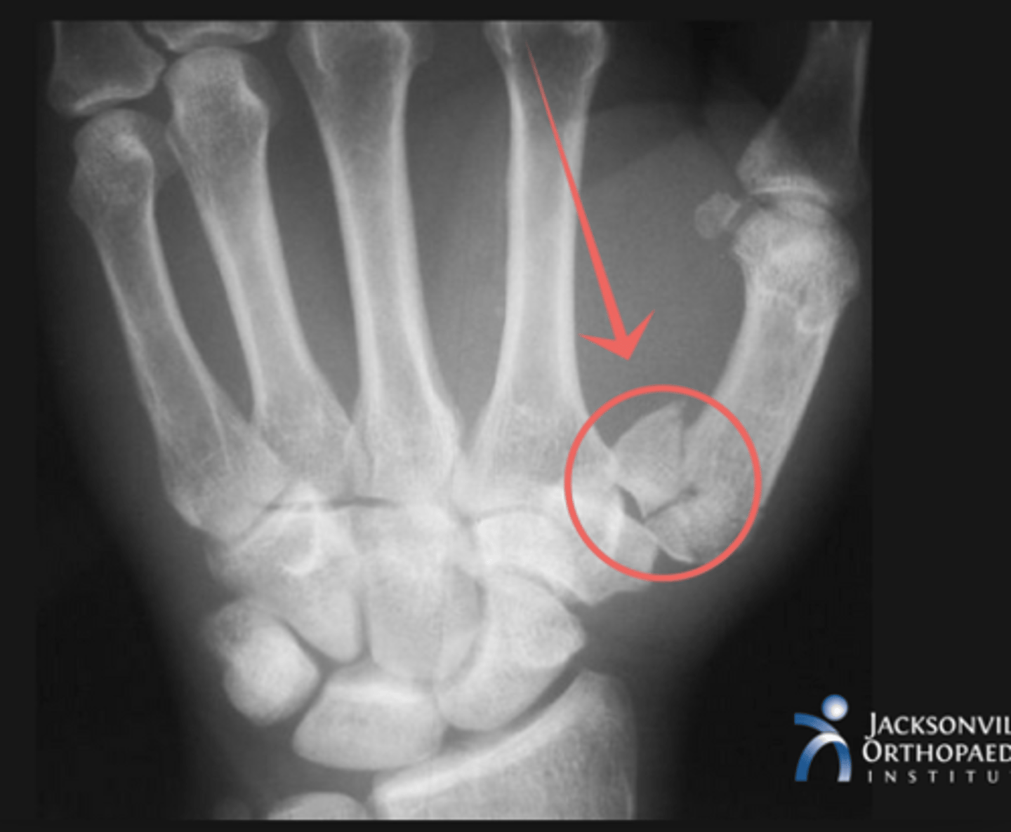 <p>First carpometacarpal joint</p><p>MOI: Impact on flexed metacarpal; Fist fights!!</p><p>X-ray: triangular fragment at ulnar base of metacarpal</p>
