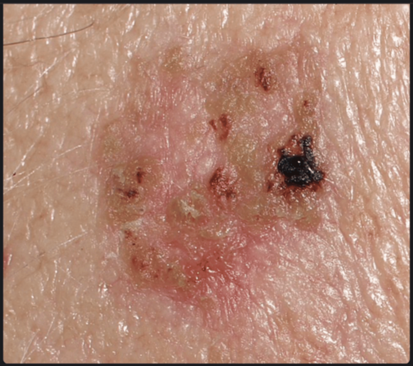 <p>- pre-malignant lesions that may turn into SCC</p><p>- irregular, red, keratinised, scaly plaques.</p>