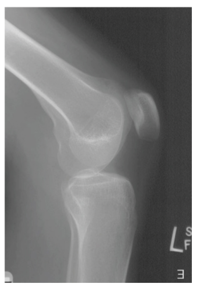 <p>A lateral knee image reveals that the femoral condyles are not superimposed with the medial condyle situated posteriorly. How should the radiographer correct this image?</p><p>a. <span>No correction needed</span></p><p>b. <span>Increase cephalic angulation</span></p><p>c. <span>Position patella closer to the image receptor (IR)</span></p><p>d. <span>Position patella further away from the image receptor (IR)</span></p>