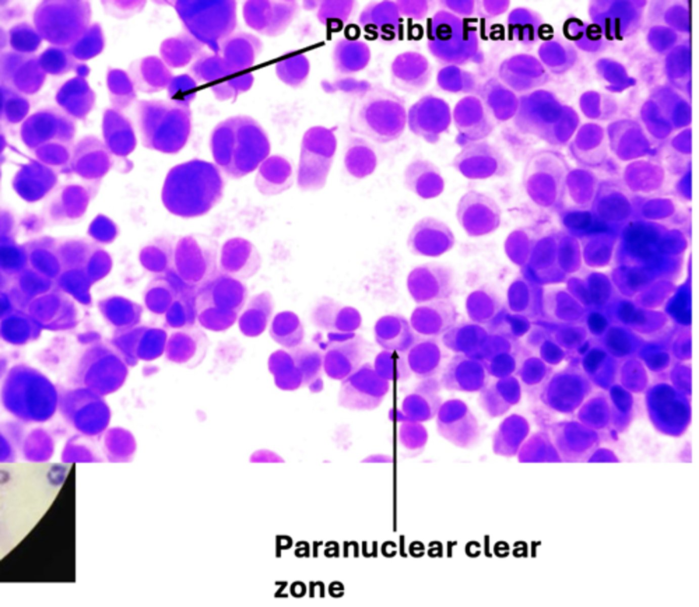 <p>What type of round cell tumor has these features?</p>