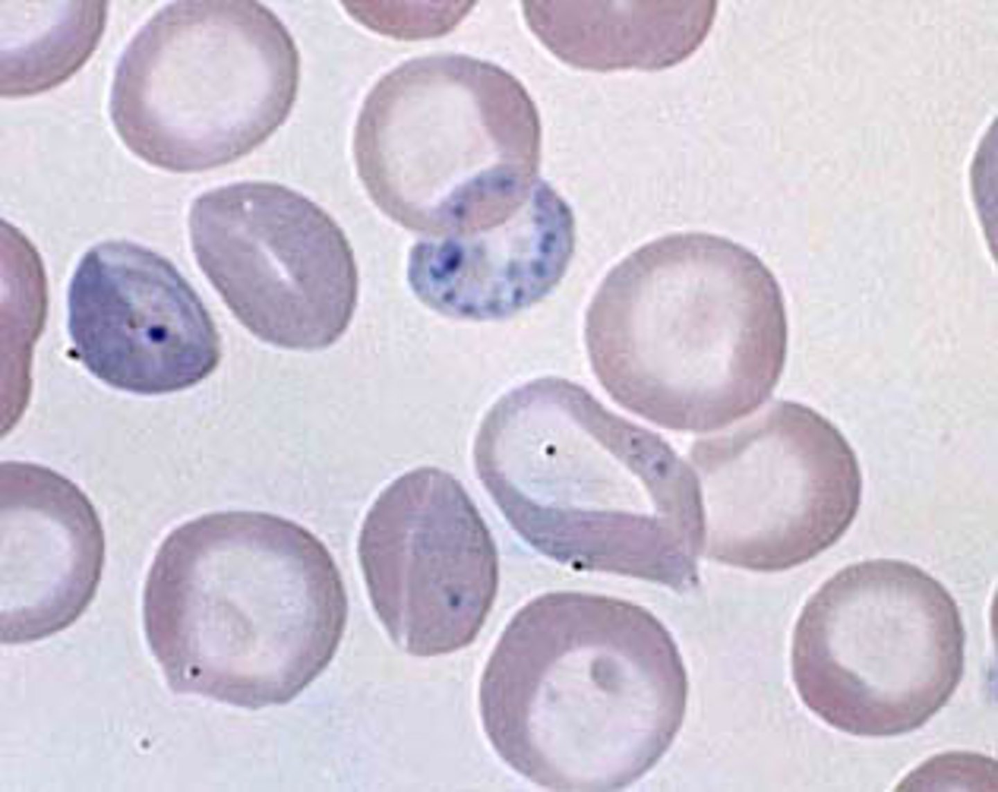 <p>deep blue stippling due to ribosomes. regenerative anemia, lead poisoning.</p>