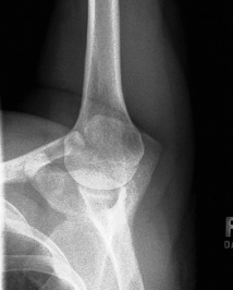 <p>evaluation criteria for PA transaxillary shoulder (hobbs method)</p>