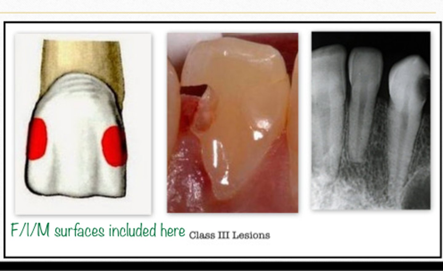 <p>GV Black Classification of Caries:</p><p>- Interproximal surface of anterior teeth</p><p>- Does NOT include the incisal edge</p>
