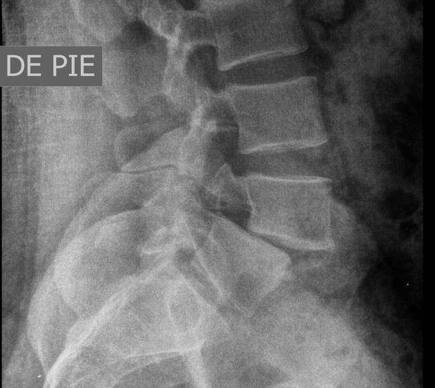 <p>Define the pathology by describing its radiographic appearance and state its symptoms</p>