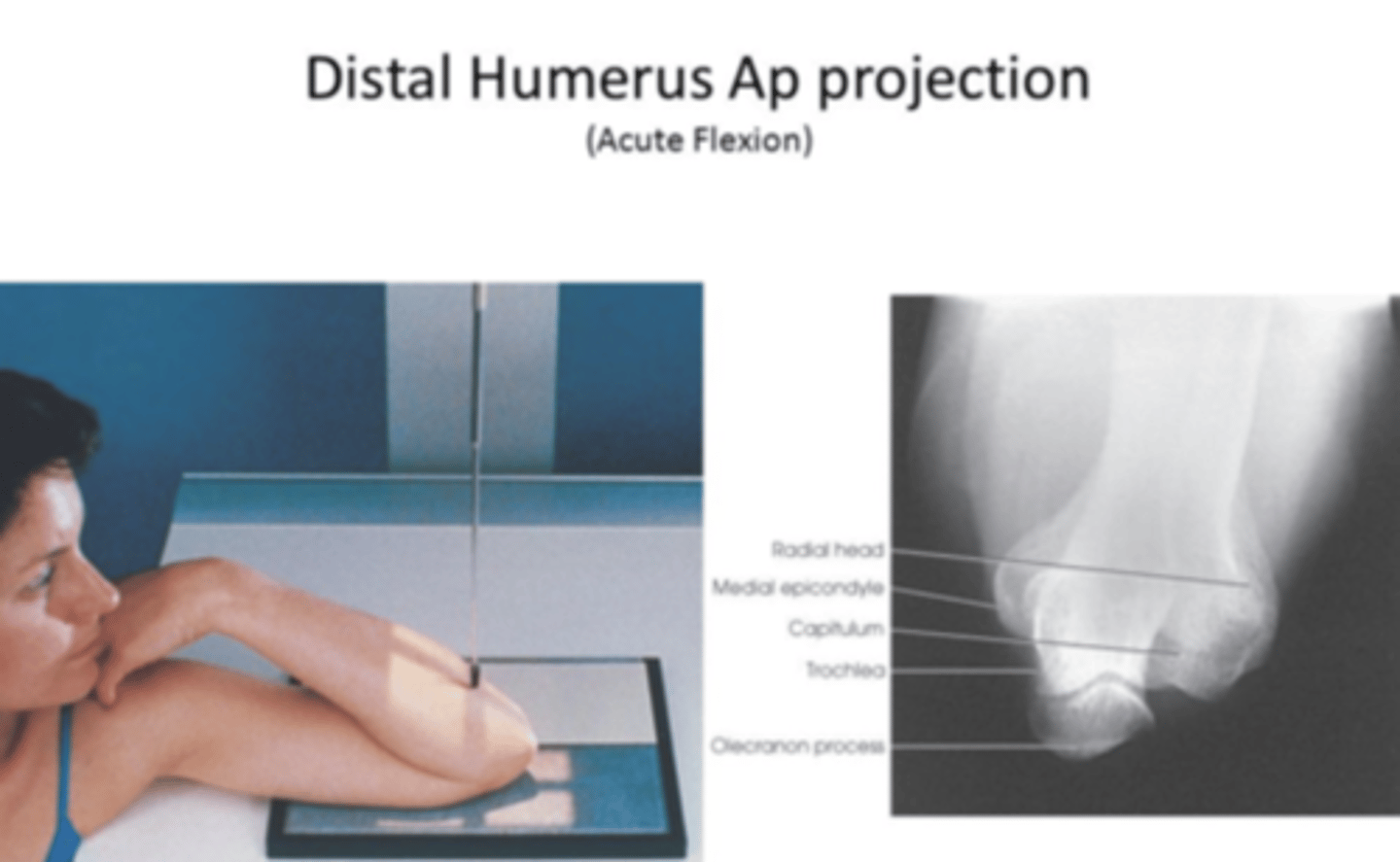 <p>The olecranon superimposes the humerus in the AP projection performed in extension.</p><p>"Superimposes" means to place or lay one thing over another, typically so that both are still evident.</p>