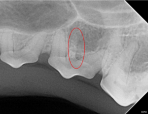 Extra roots on a tooth.