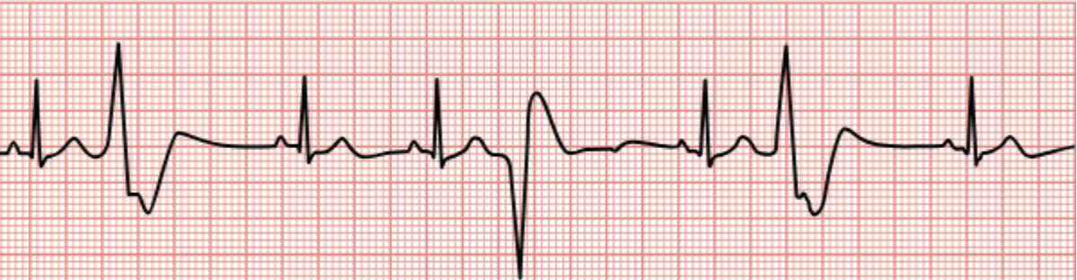 <p>Premature contractions in the ventricles that affect the QRS wave.</p>