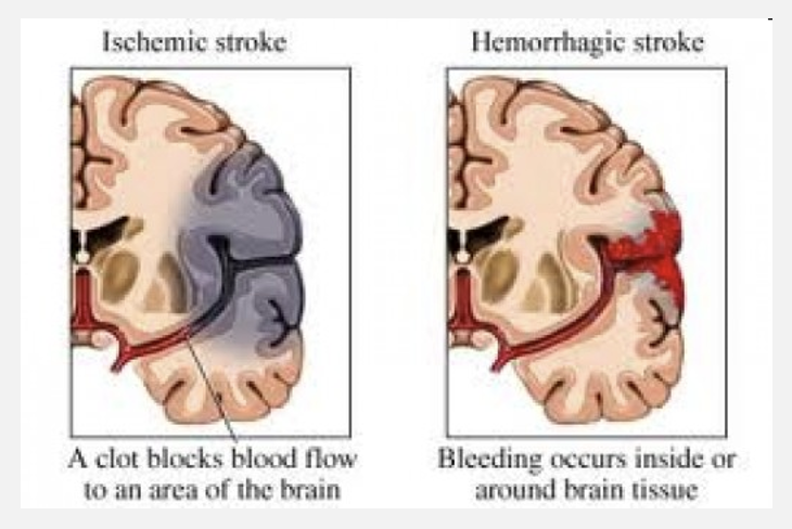 <p>consequences of an ischemic stroke</p>