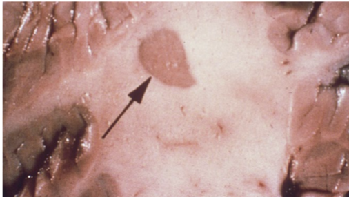 <p>What is this and what disease is it seen in </p>