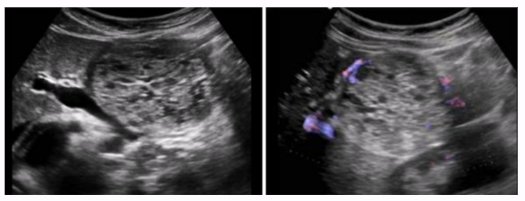 <ul><li><p><span style="background-color: transparent;">Tumor with multiple cysts < 2cm</span></p></li><li><p><span style="background-color: transparent;">Possible calcifications</span></p></li><li><p><span style="background-color: transparent;">Occurs mainly in head</span></p></li></ul><p></p>