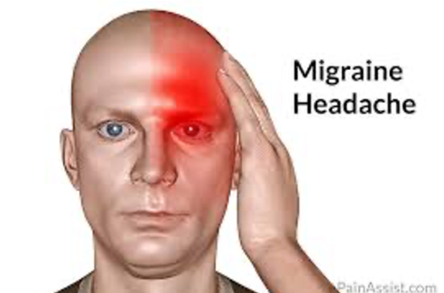 <p>an intense constant headache surrounding the entire head</p><p>manifestations:</p><p>- N/V</p><p>- sensitivity to light/noise</p><p>- head throbbing</p><p>- dizziness</p><p>- neck pain/stiffness</p>