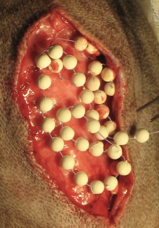 <p><span>Antibiotic beads are a type of local delivery system. They deliver high local concentrations of antibiotics in ischemic areas with minimal or no systemic side effects. </span>They are usually not used as the initial treatment and can have variable elution. </p><p><span>This method is beneficial in cases where systemic antibiotic therapy may be less effective due to biofilm formation or when the infection is surrounded by a large amount of necrotic or damaged tissue. They are particularly useful in conjunction with surgical debridement.</span></p>