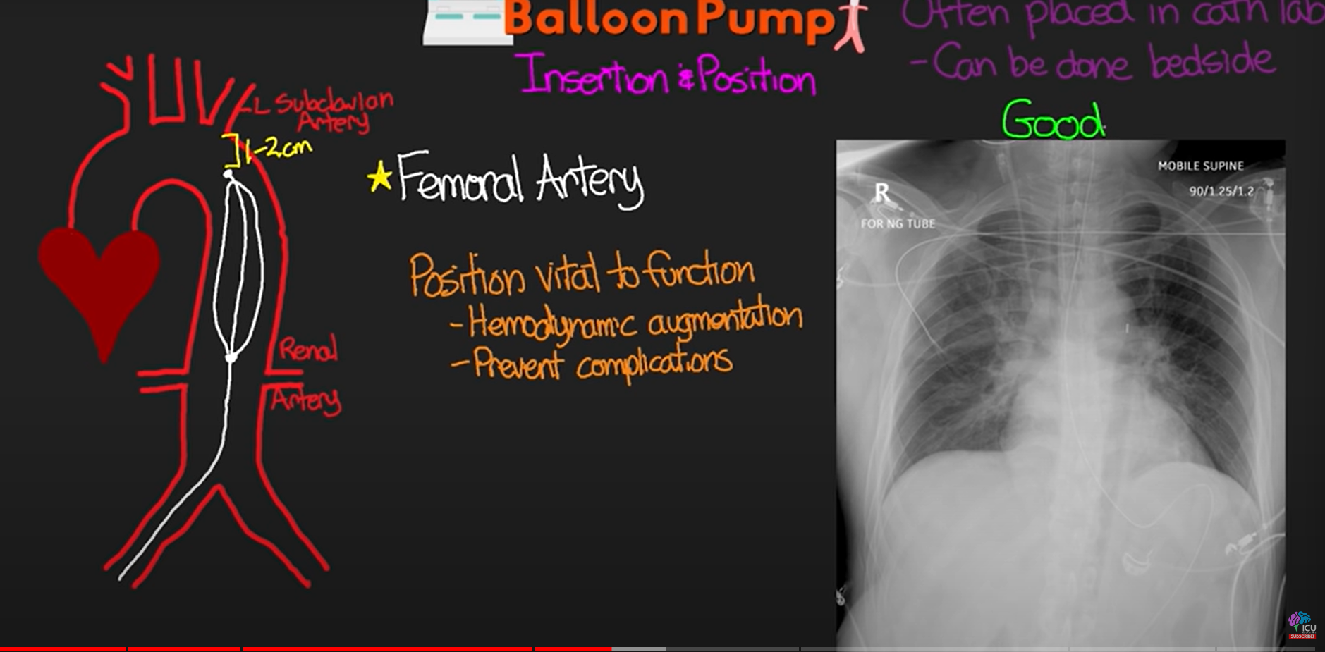 <p>tip of balloon resting just before aortic arch, 1-3 cm distal to left subclavian artery </p><p>bottom of balloon</p><p>just above the renal arteries</p><p></p>