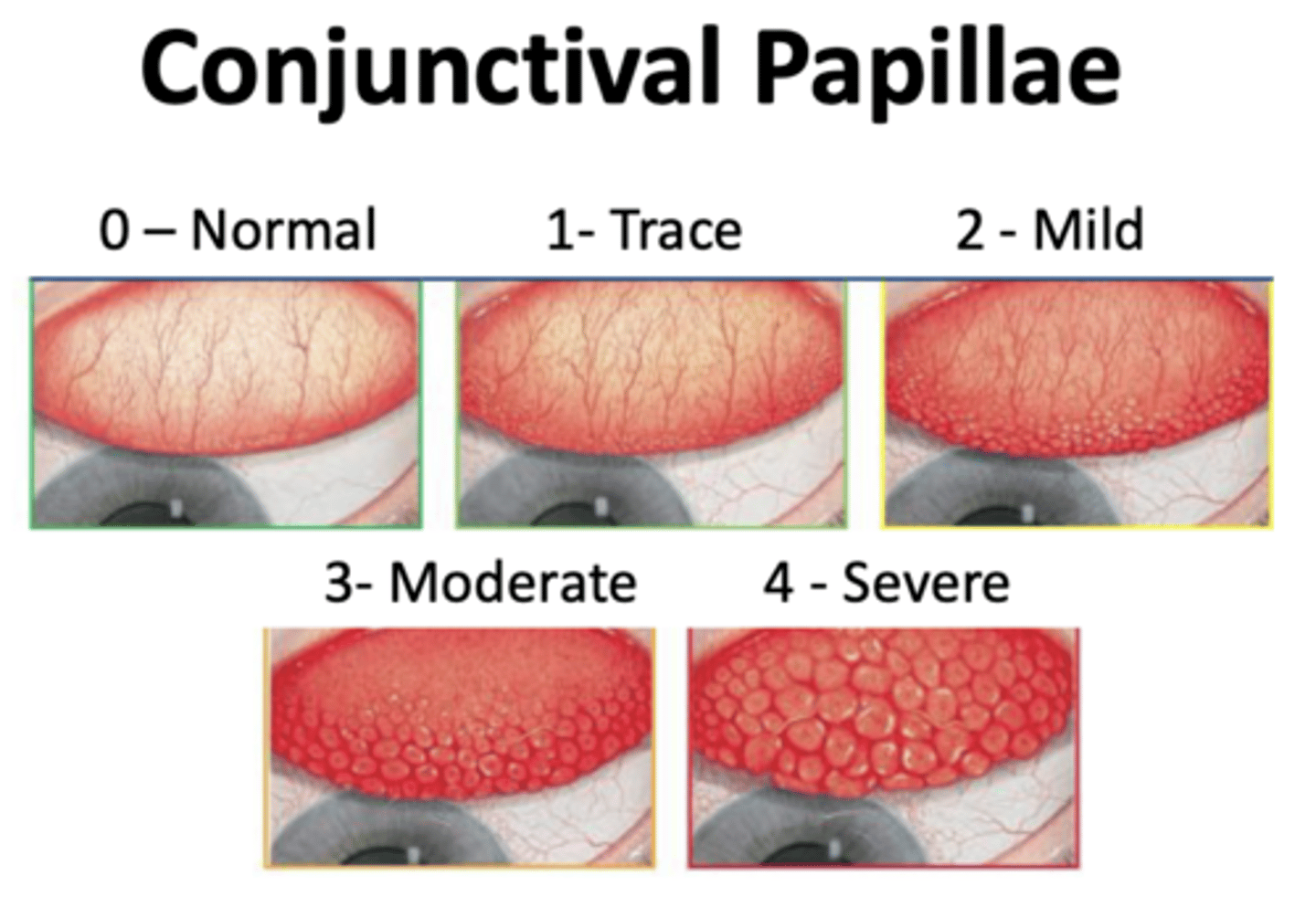 <p>What is it called when there is hyperplasia (increase in number of cells) of the epithelium?</p>