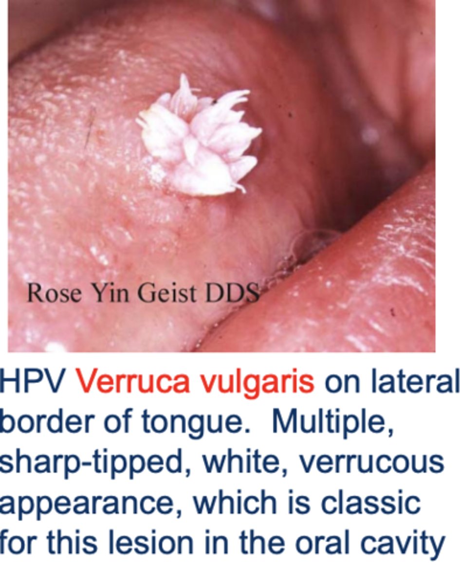 <p>HPV-2 and -4 are common cause</p><p>Benign</p><p>Treated with excision and or cryotherapy</p>