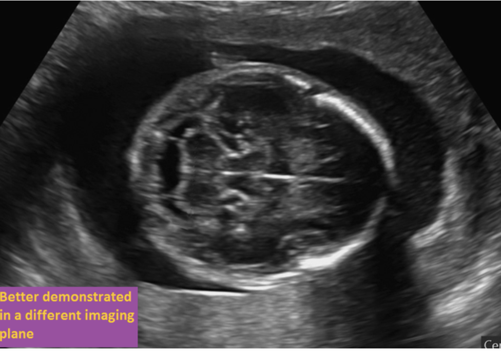 <p>if the fetus is breech, where is the left lobe of the thalamus</p><ul><li><p>The fetus is in breech position and facing the maternal left side</p></li><li><p>The '“fetal left side is posterior” and the fetal right side is anterior on the image.</p></li></ul><p></p>