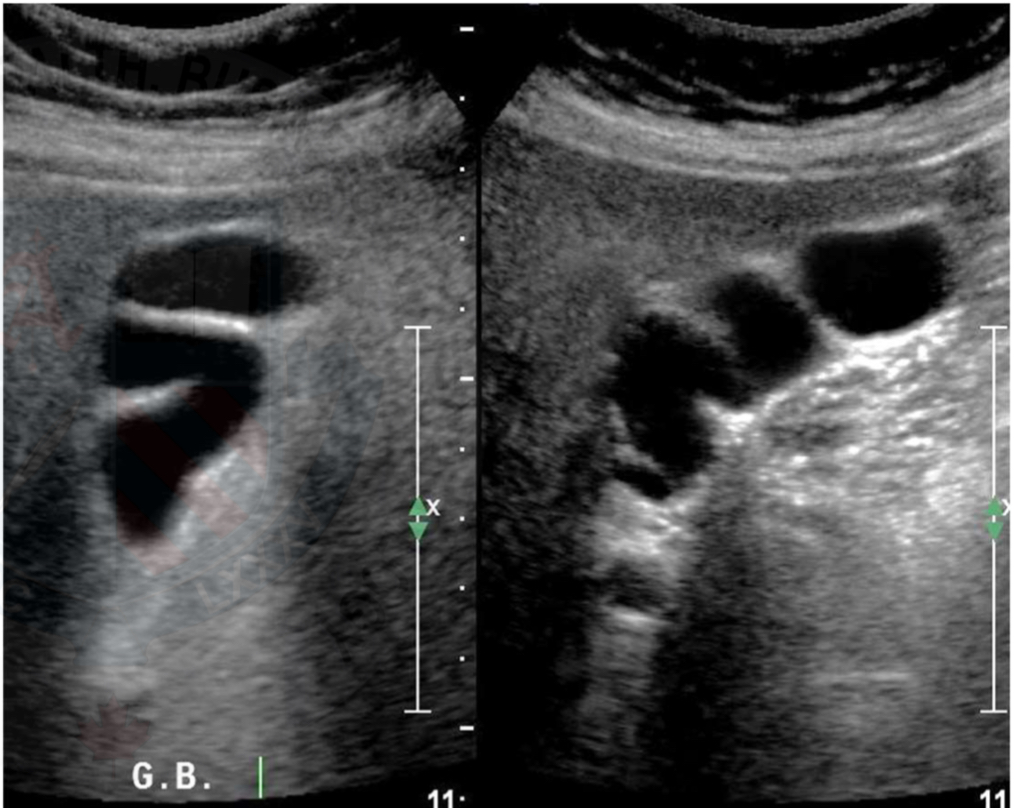 <p>Folds are commonly seen and are normal </p>