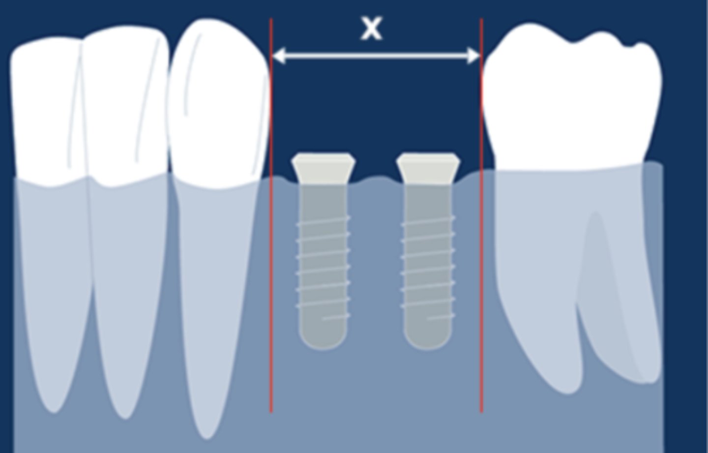 <p>The minimum safe distance between two teeth (dimension X) to allow placement of two 3.3 mm implants is _____ . (select one answer)</p><p>12mm</p><p>13mm</p><p>14mm</p><p>15mm</p>