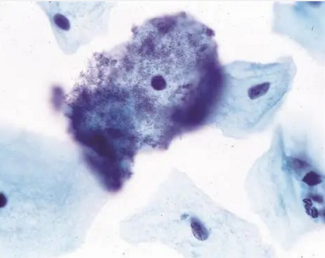 <p>what is bacterial vaginosis?</p>