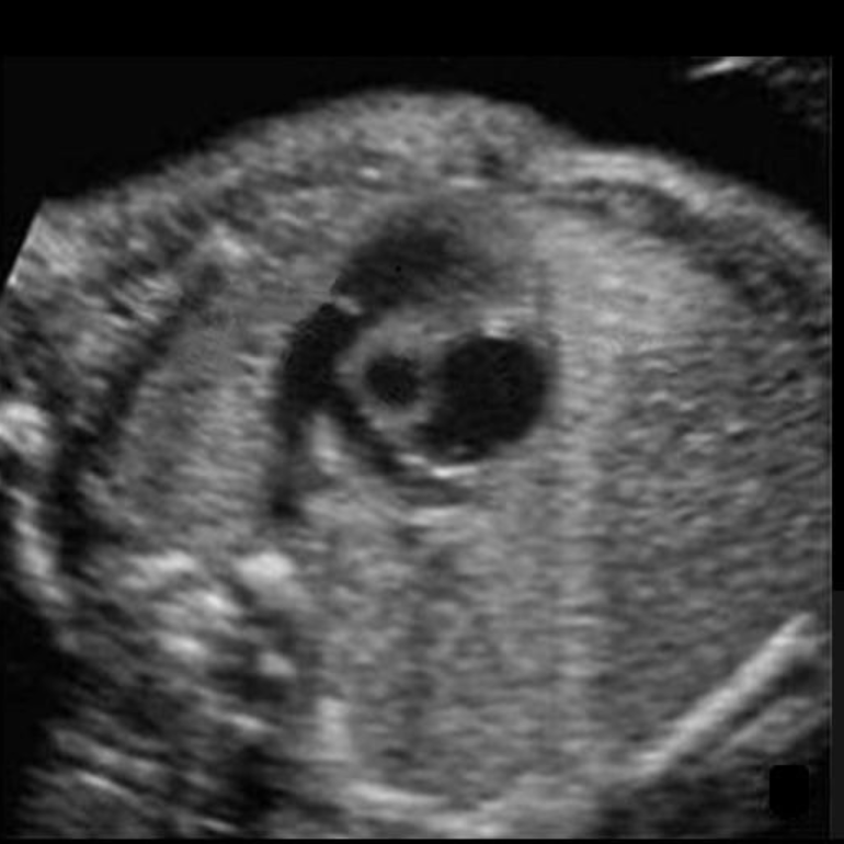 <p>where is the right ventricle</p><ul><li><p>write “the most anterior spot on the picture”</p></li></ul><p></p>